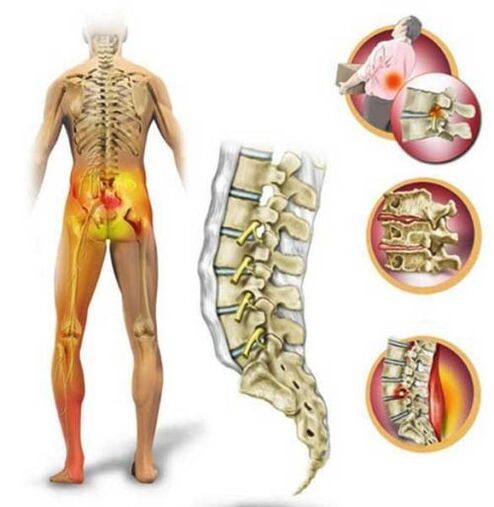 Osteochondrosis of the lumbar spine, which causes back pain