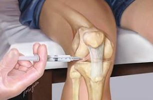The injection in addition