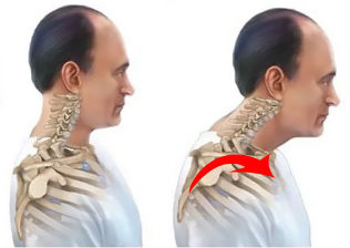 healthy and sick of the spine