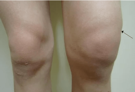 Emartrosis of the knee joint