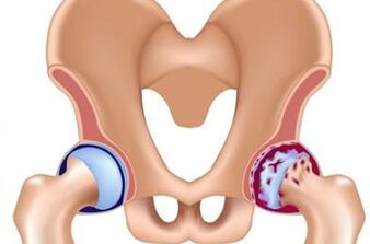 Development phase of the arthrosis of the hip joint