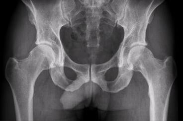 Diagnostic options for the arthrosis of the hip joint