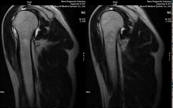 x-ray to diagnose shoulder arthritis
