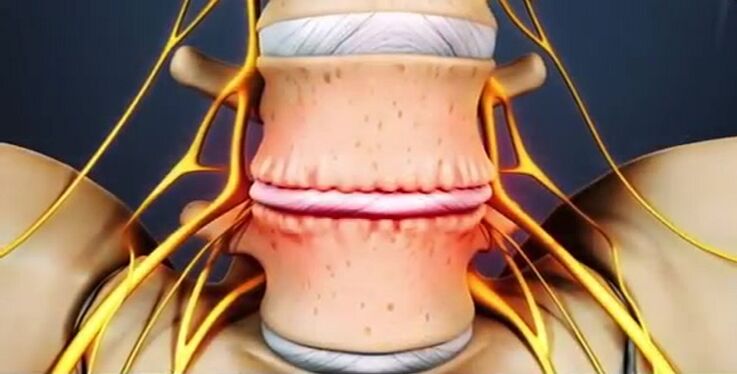 spinal lesions due to osteochondrosis
